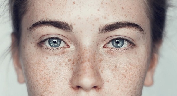 Phương pháp chăm sóc da mặt bị tàn nhang — Blog chăm sóc da