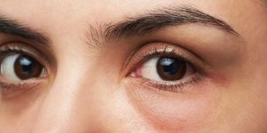 Vitamin k và caffeine có thể giúp làm giảm bọng mắt