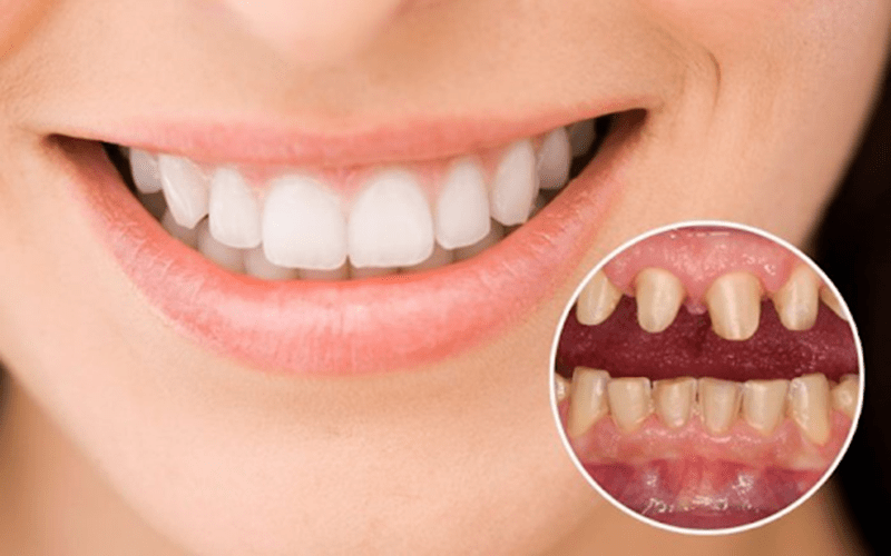 Bọc răng sứ có đau không?