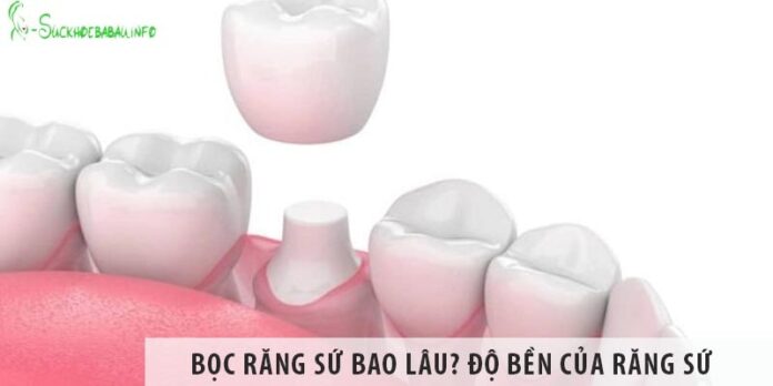 Bọc răng sứ bao lâu? Tìm hiểu về độ bền của răng sứ