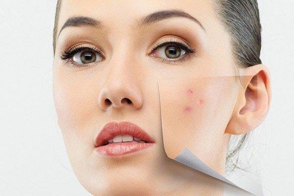 Loại sạch thâm mụn với serum giúp giảm thâm mụn murad post-acne spot lightening gel
